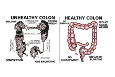 colon-health